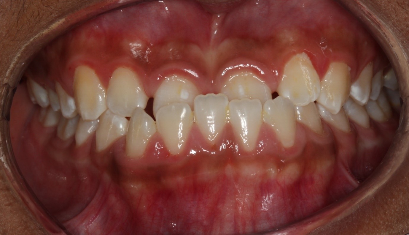 Common Teeth Issues Where Orthodontics Can Help - Orthodontics New Zealand