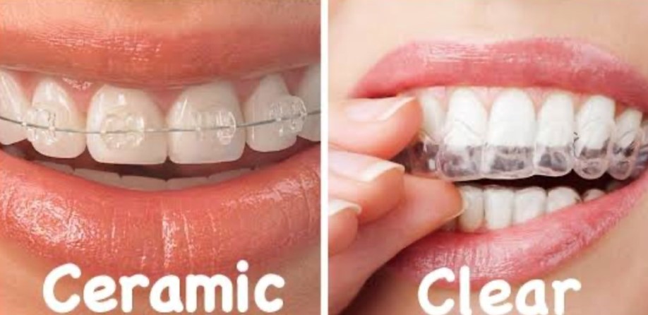 Braces For Adults: What to Know About Clear Aligners - Inner Banks Dental