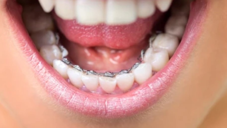 adult with lingual braces