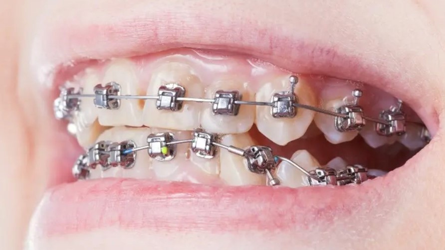 Self-ligating braces on adult patient