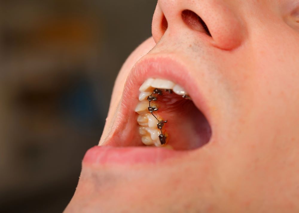 person wearing lingual braces