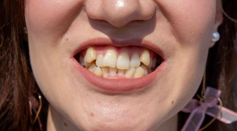 Front view of woman's smile with severe teeth crowding