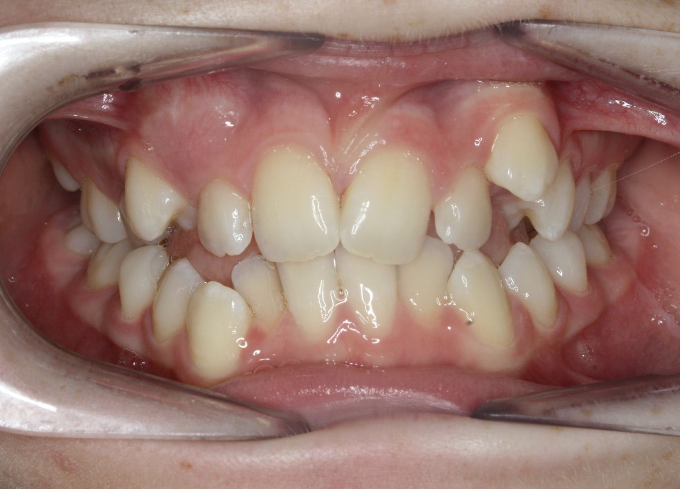 Close up of teeth overlapping each other on both the upper and lower jaw