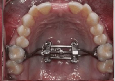 roof of mouth with mini screw assisted rapid palatal expansion
