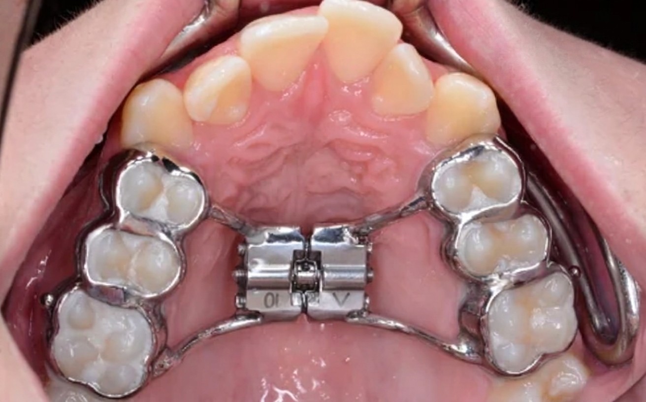 roof of mouth with a palatal expander attached to the molars