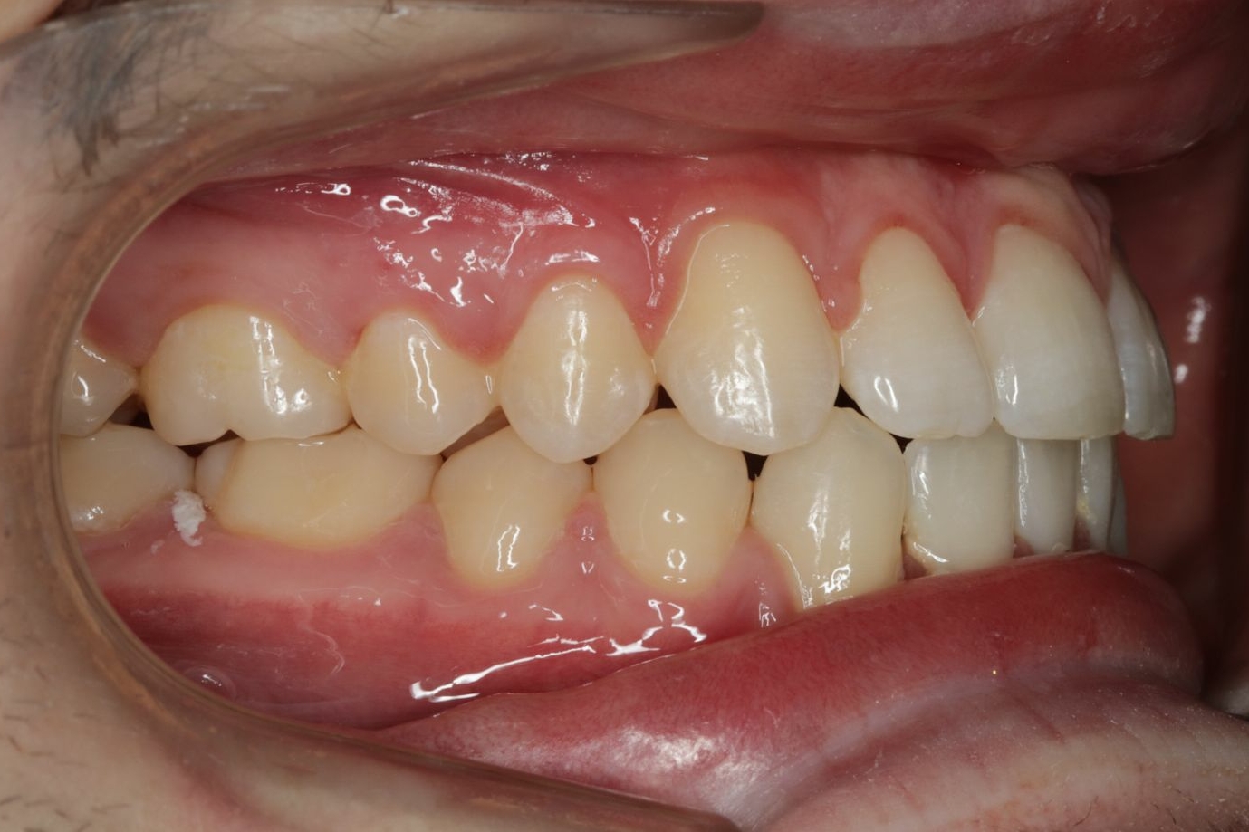 Side view of teeth correctly aligned post surgery